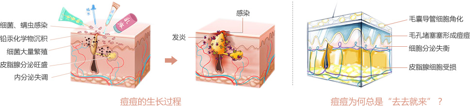 痘痘的生长过程